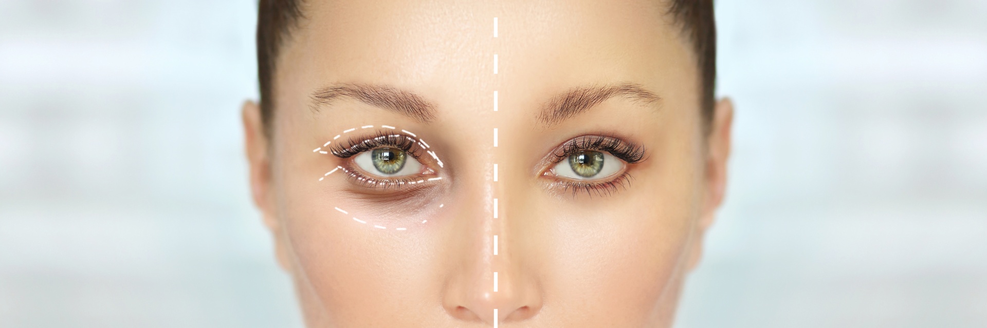 Seven detailed facts about eyelid surgery at MediEsté Clinic